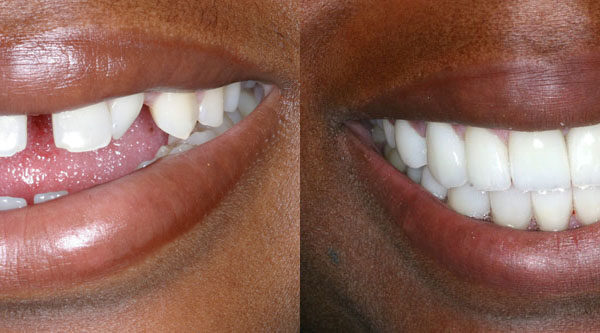 Cosmetic Dentistry Before and After photo by Dr. Cohen in Beverly Hills, CA