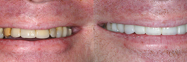 Cosmetic Dentistry Before and After photo by Dr. Cohen in Beverly Hills, CA