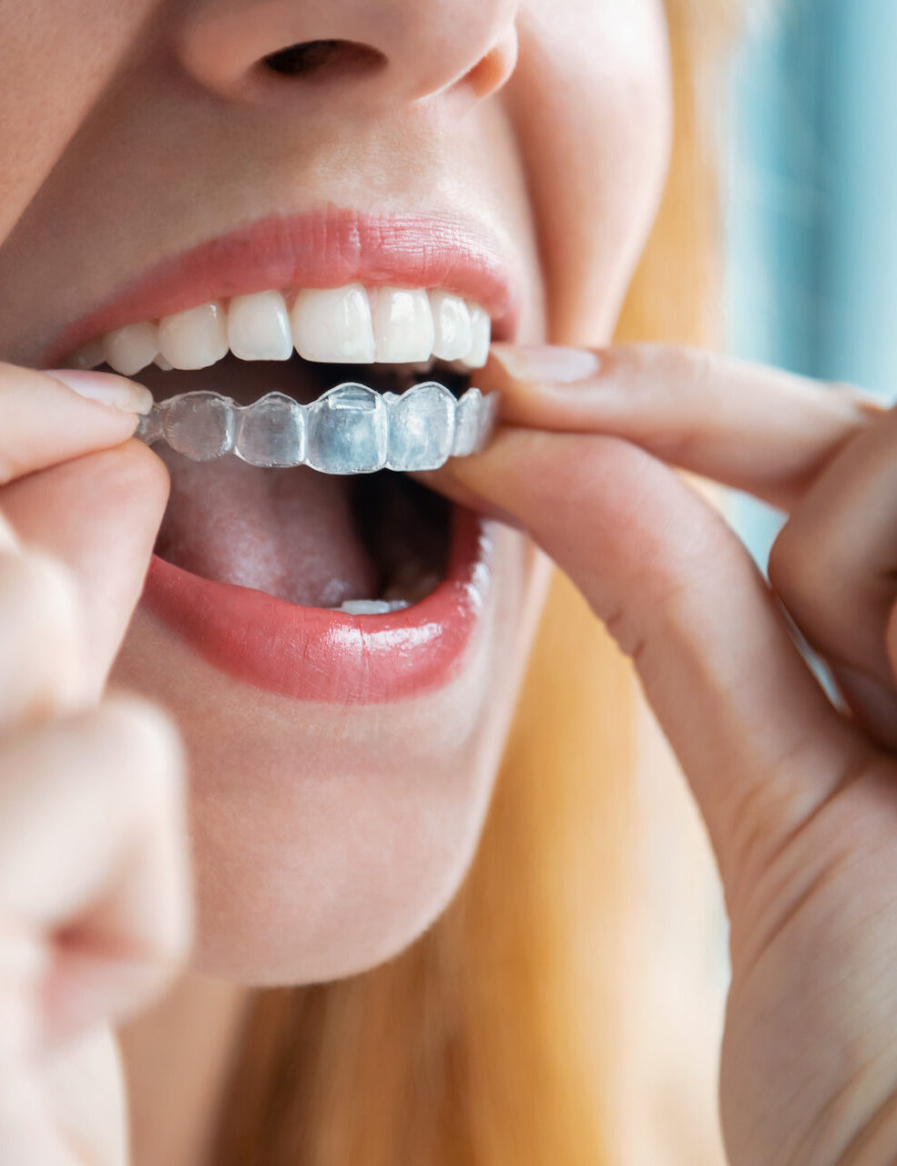 woman putting in invisalign retainer